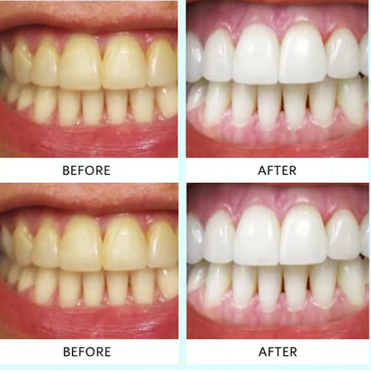 Teeth Whitening Strips (box1)